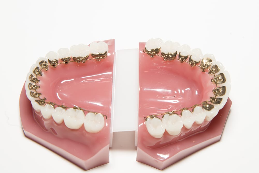 What is a Lingual Braces (Invisible Braces)